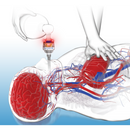 Zoll ResQPOD ITD 10 Impedance Threshold Device-Zoll-HeartWell Medical